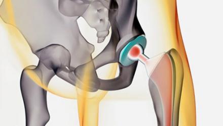 hip-fracture-xray-500x